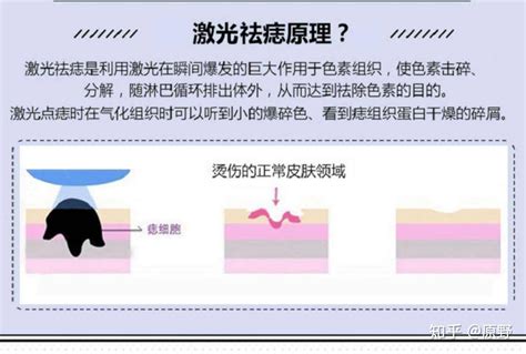 如何消痣|面部去痣的最好方法